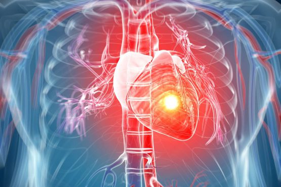 نارسایی قلبی- دکتر منیژه فلاح -فوق تخصص نارسایی قلبی و پیوند قلب